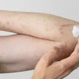 Arm mit Hautausschlag und Rötungen, möglicherweise durch eine Polyester-Allergie verursacht. Eine Hand trägt eine weiße Salbe auf.