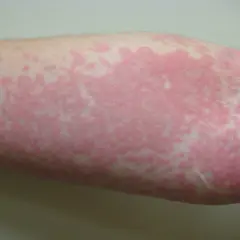 Roter Hautausschlag am Arm, möglicherweise ein Ausschlag durch neue Kleidung. Was tun?