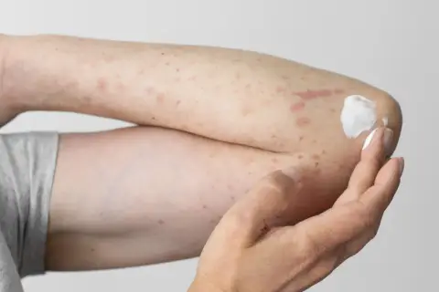 Arm mit Hautausschlag und Rötungen, möglicherweise durch eine Polyester-Allergie verursacht. Eine Hand trägt eine weiße Salbe auf.