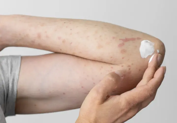 Arm mit Hautausschlag und Rötungen, möglicherweise durch eine Polyester-Allergie verursacht. Eine Hand trägt eine weiße Salbe auf.