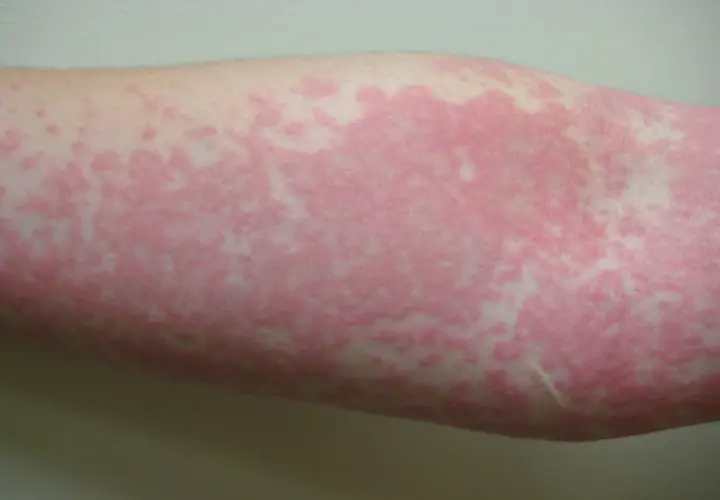 Roter Hautausschlag am Arm, möglicherweise ein Ausschlag durch neue Kleidung. Was tun?