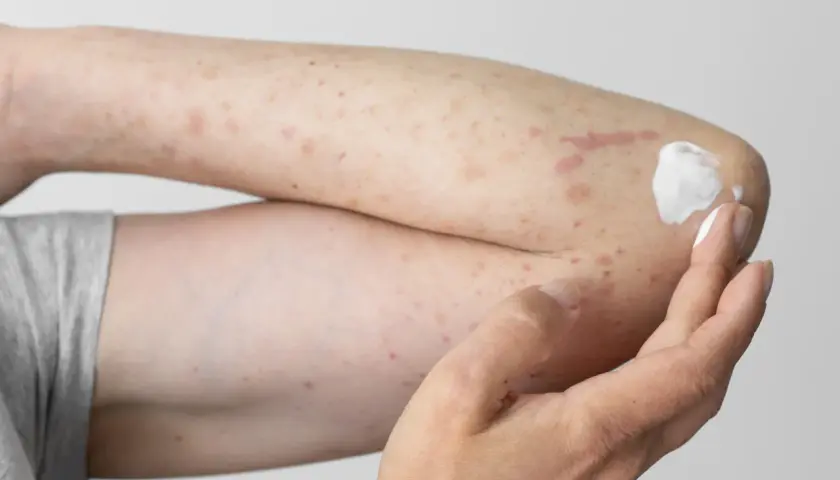 Arm mit Hautausschlag und Rötungen, möglicherweise durch eine Polyester-Allergie verursacht. Eine Hand trägt eine weiße Salbe auf.