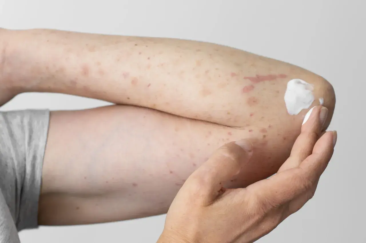 Arm mit Hautausschlag und Rötungen, möglicherweise durch eine Polyester-Allergie verursacht. Eine Hand trägt eine weiße Salbe auf.