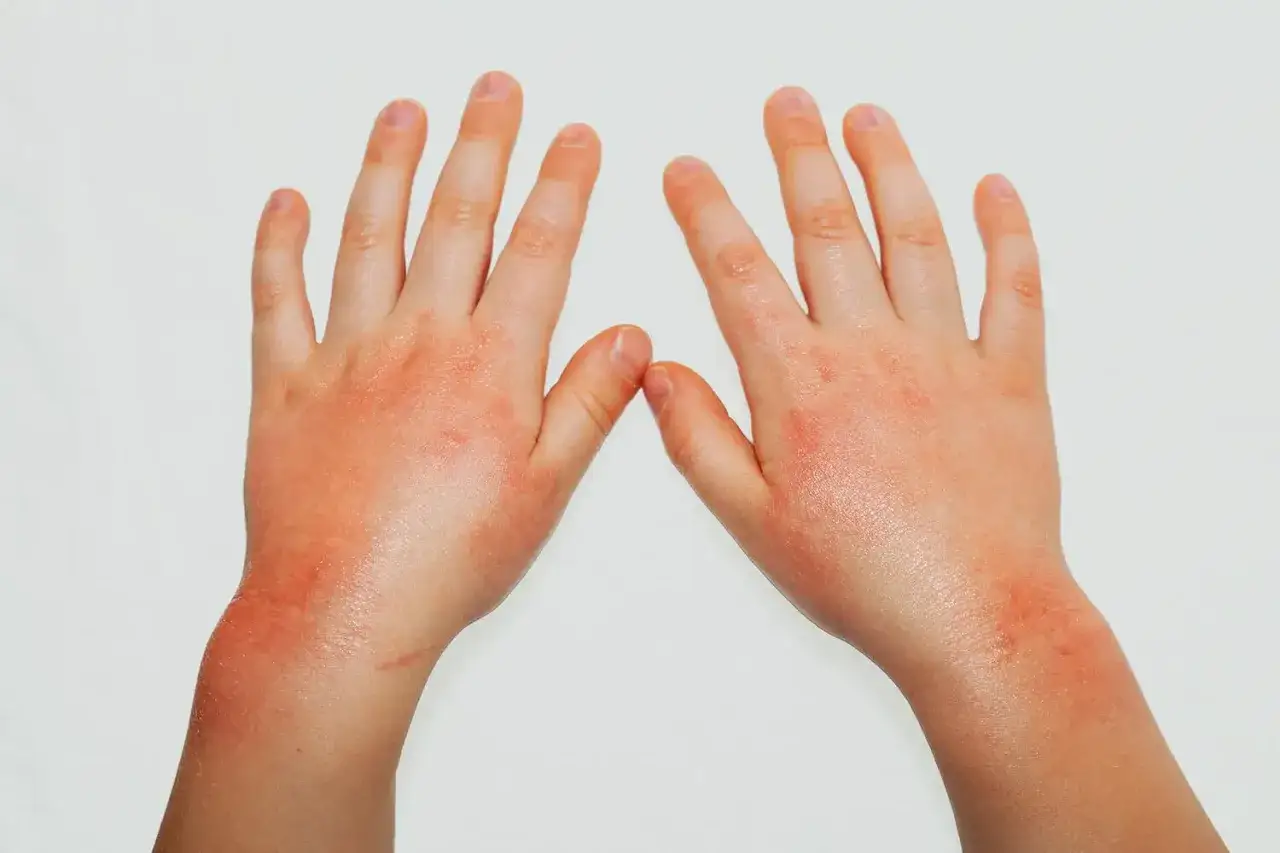 Rote, gereizte Hände mit Ausschlag, möglicherweise eine Polyester-Allergie. Die Haut ist geschwollen und juckt.